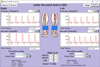 Ankle Brachial Index