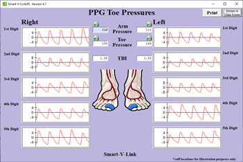 PPG Toe Pressures