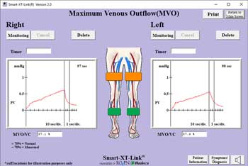 Maximum Venous Outflow