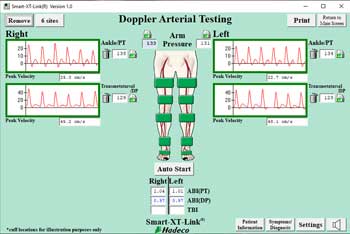 Ankle Brachial Index