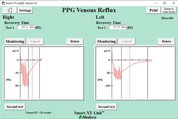 PPG Venous Reflux